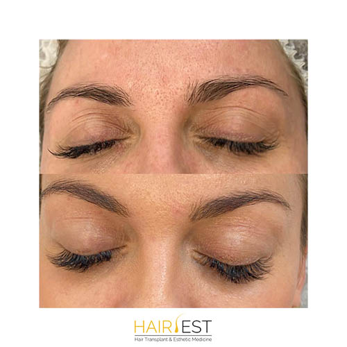 blefaroplastyka powiek tixel lublin